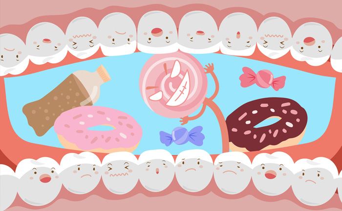 Caries dentaires